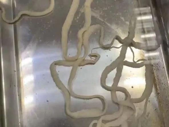 女子吃完火锅体内排出4米长绦虫她的饮食习惯许多老广都有