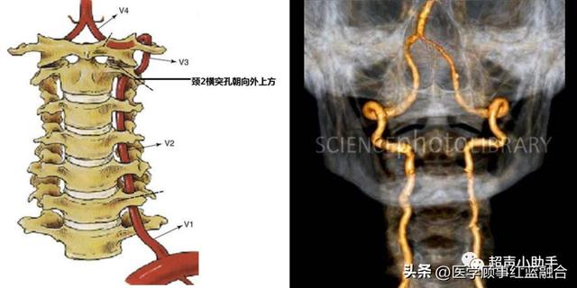 椎-基底動脈系統供應腦幹,小腦,丘腦,枕葉,顳葉底部,後循環缺血,會