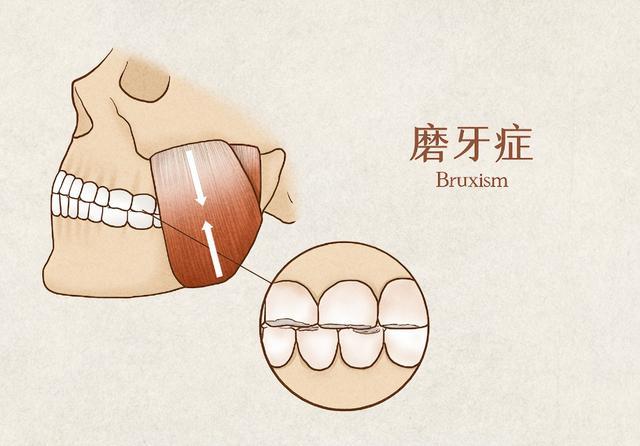除了晚上會發出吱吱吱的磨牙聲,早上醒來還會感到頭疼,耳朵疼等