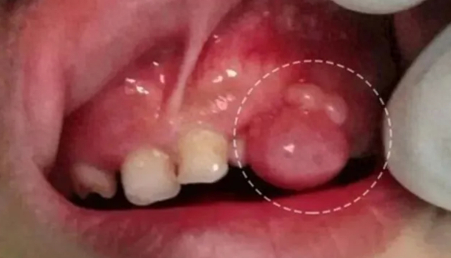 脓包|牙龈|牙齿_新浪新闻