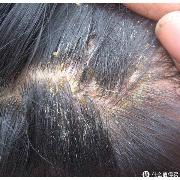 洗发水控油止痒去屑推荐|头皮屑_新浪新闻