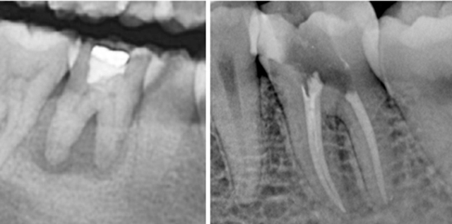 临床的表现症状与慢性牙髓炎的疼痛的特点相似
