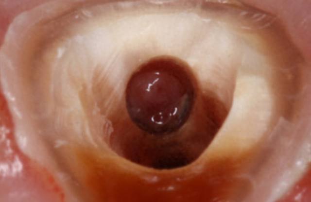 根管穿孔的处理方法|手术_新浪新闻