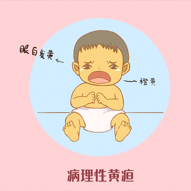 新生儿黄疸隐藏着不小风险,如何正确认识,治疗,预防,这里给你说清楚