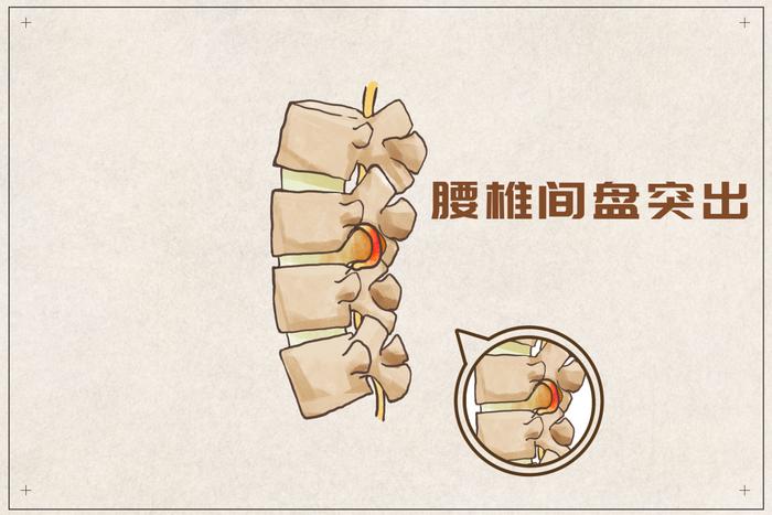 腰椎间盘突出与腰椎间盘突出症