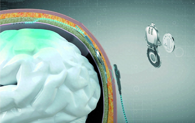 无线微创植入脑机接口NEO系统及其体内机的设计合成图（清华大学供图）