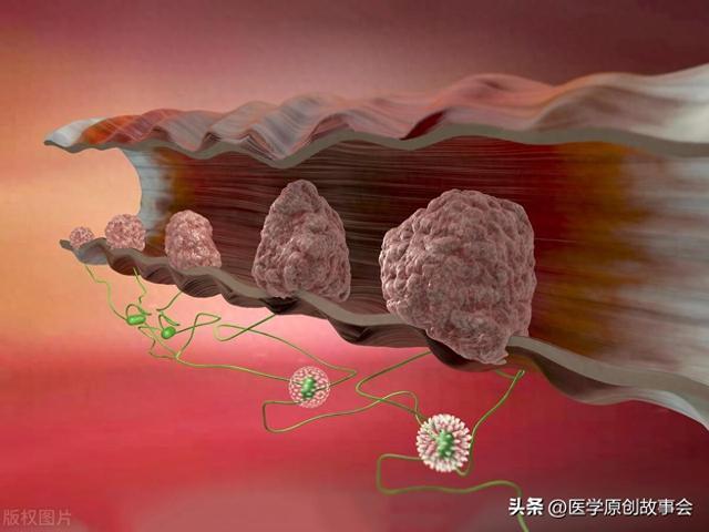 醫生,我總是有排便不盡的感覺,是不是得了直腸癌啊.