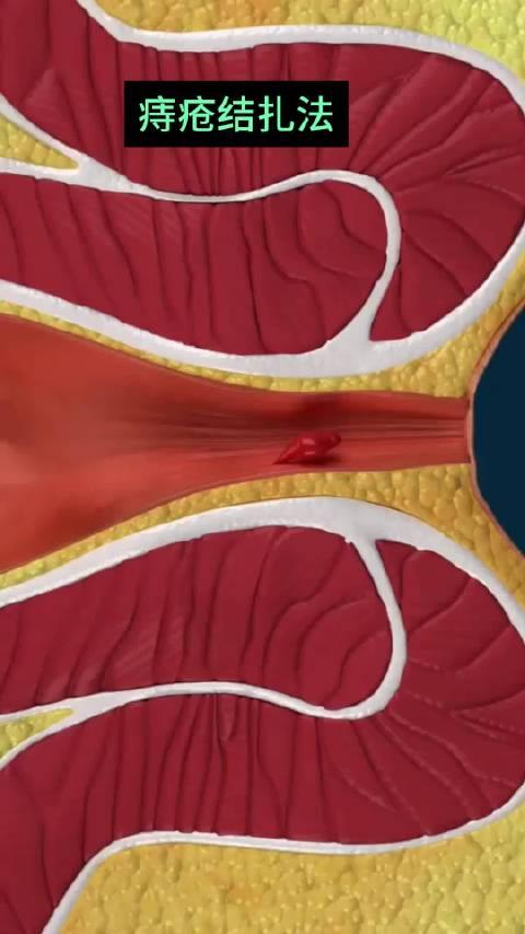 痔核坏死脱落图片图片