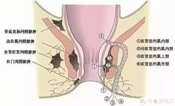 中年男士的人生第一刀"混合痔 肛瘘"术后第一周恢复