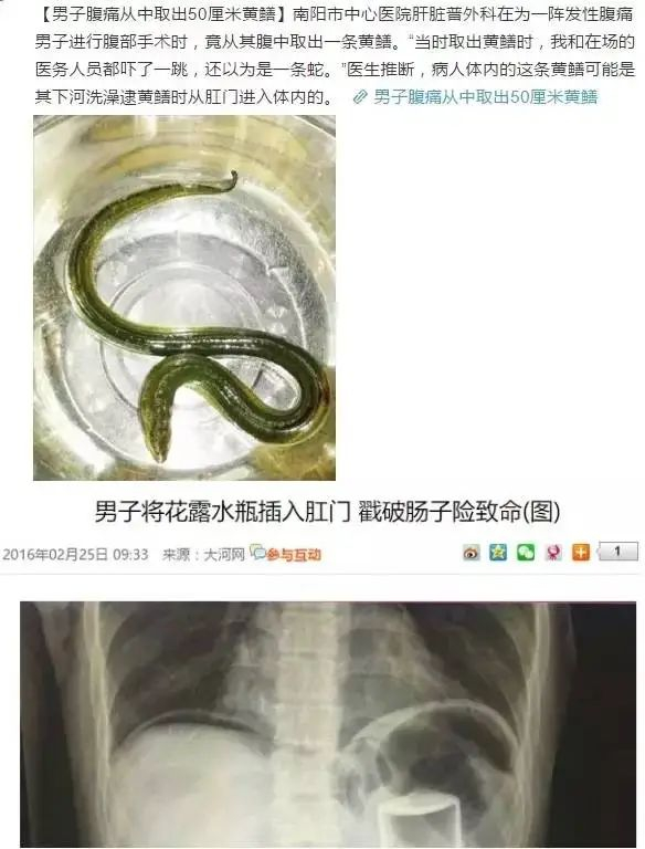 进去容易出来难:直肠异物,问题比"丢脸"严重得多!