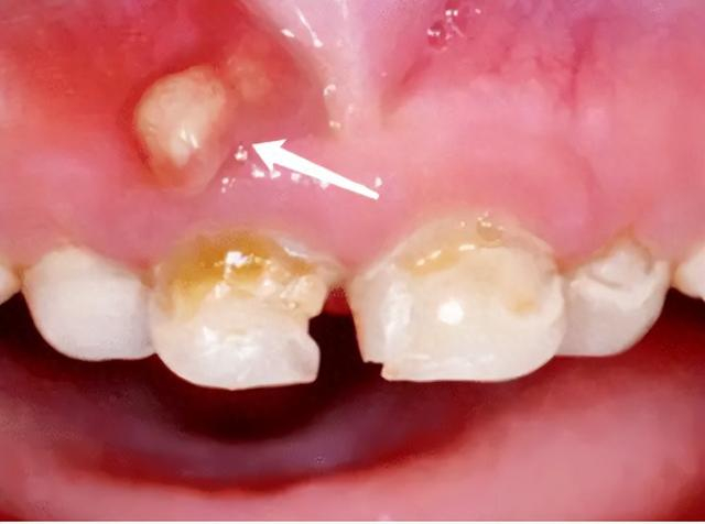牙龈上长脓包的危害可不能小觑|周炎|牙齿|感染_新浪新闻