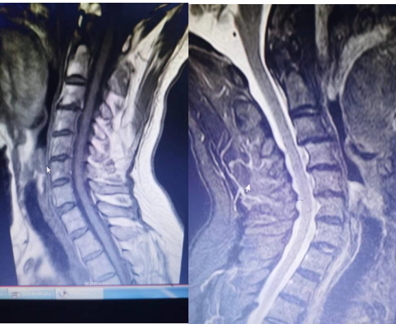 诸椎体边缘骨质增生，椎间隙未见明显狭窄，椎小关节硬化、模糊，项韧带见斑点样钙化影。