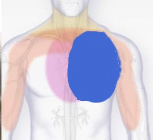 图1 患者心绞痛部位