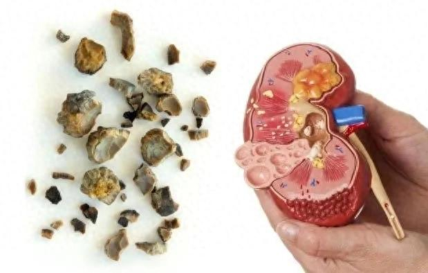 肾结石和输尿管结石的辨证论治