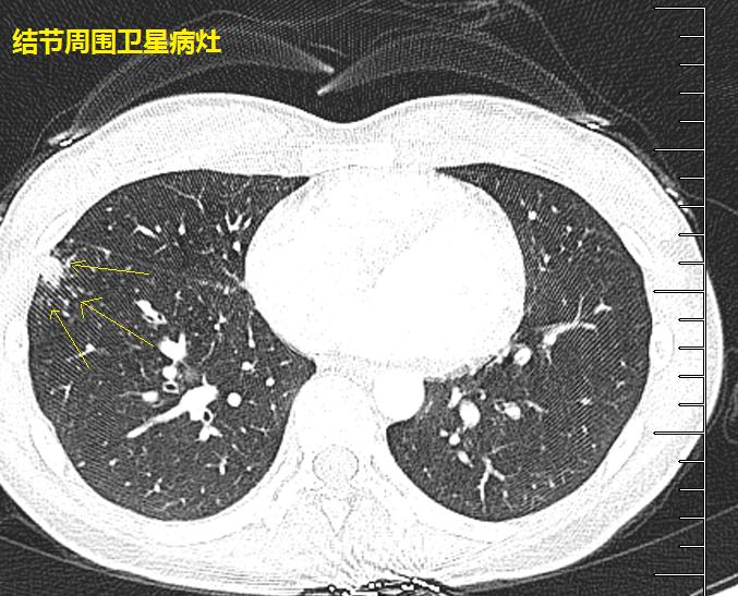 圖6-12結節 衛星病灶 縱隔淋巴結多發腫大 年輕人,首先考慮結核.但是