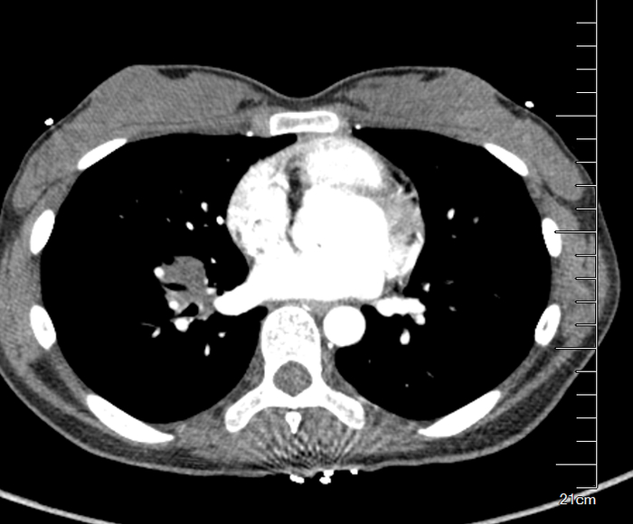 肺上一小点病灶,却让患者反复高热,这种病例你会怎么?
