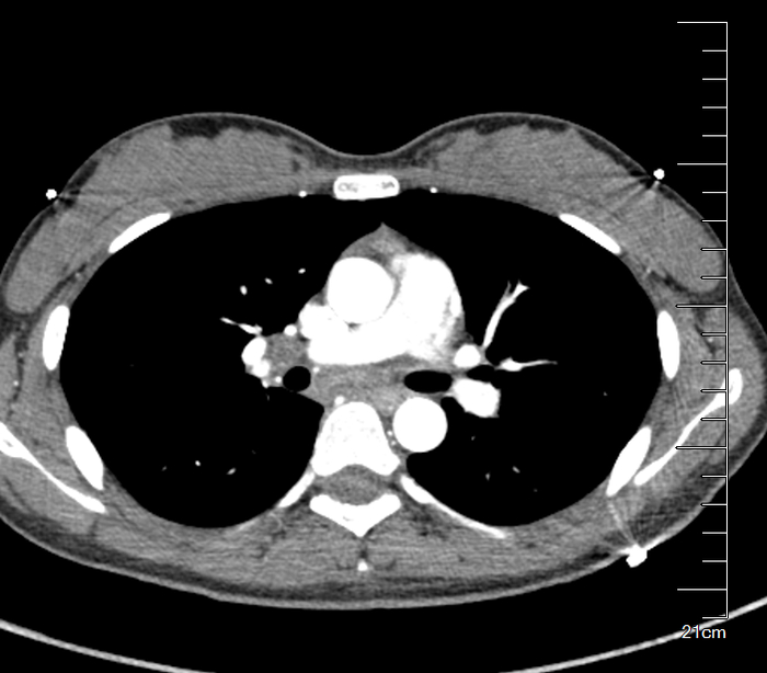 肺上一小点病灶,却让患者反复高热,这种病例你会怎么?