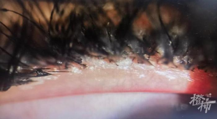 裂隙灯显微镜下相片露出睫毛根部（睑缘）充血、沾满了胶水