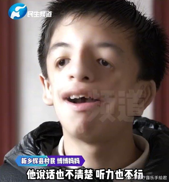 "鸟面综合征"类似小鸟样的脸,眼睛比较小,鼻子呈鹰钩鼻……_新浪新闻