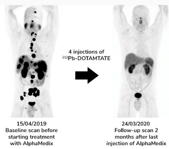▲于1期临床试验中，转移性神经内分泌肿瘤患者接受AlphaMedix治疗的结果（图片来源：Orano Med公司官网）