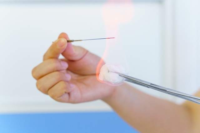 咽炎最好的方法就是火针治疗|咽炎|火针|疗效_新浪新闻