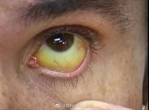 结膜发黄:眼科医生介绍一下肝脏病变合并的眼睛表现