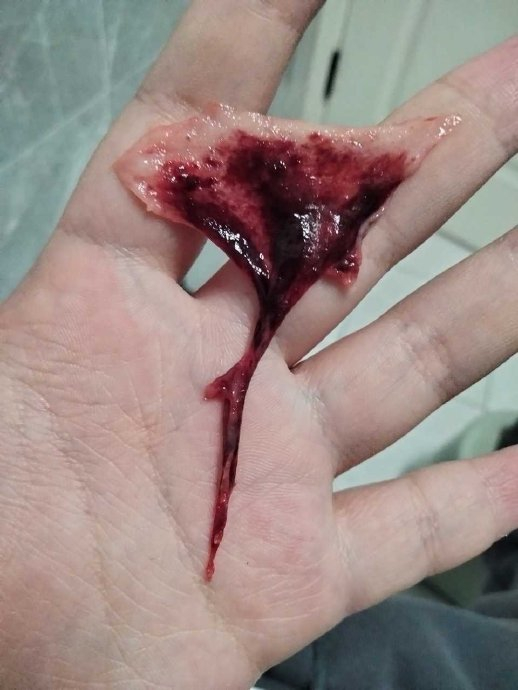 这是emmm,姨妈期来的,我知道这应该是脱落的子宫内膜,but,第二张图的