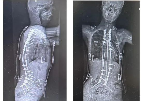 小宝术后的影像学结果。图源/受访者提供