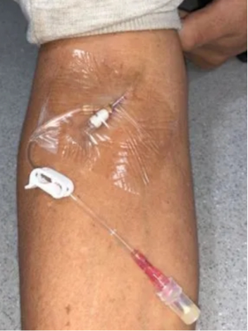 浅静脉留置针健康宣教|输液|血管|护士_新浪新闻