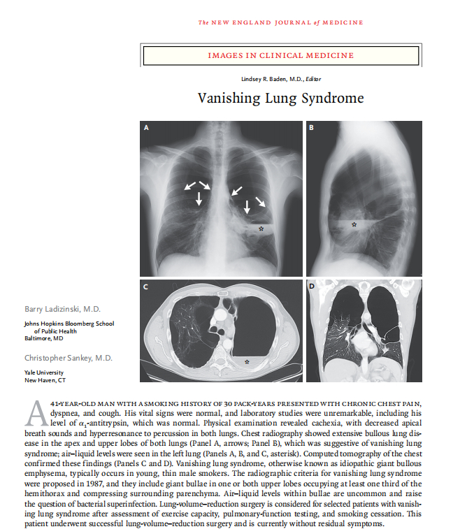 面对巨大肺大疱呼吸科医生该如何处理