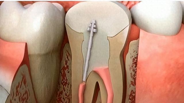 根管治疗到底有多可怕?一定非做不可吗?你需要好好了解下了