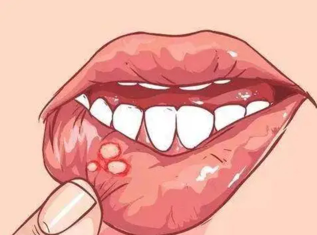 所以以控制症状为主4 多喝胡萝卜汁5 若是溃疡长期不愈合或是变大