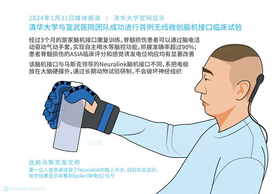     首例无线微创脑机接口临床试验成功示意图。视觉中国供图