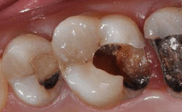 这几种食物比糖还伤牙,你中招了吗?|牙齿|蛀牙|龋齿_新浪新闻