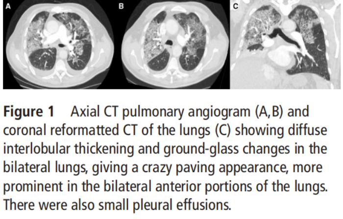 首发表现为肺出血千万不要再被这种叛逆的血液病欺骗了
