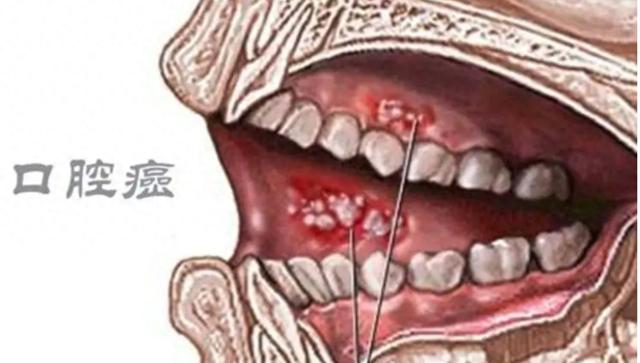 口腔癌的原因图片