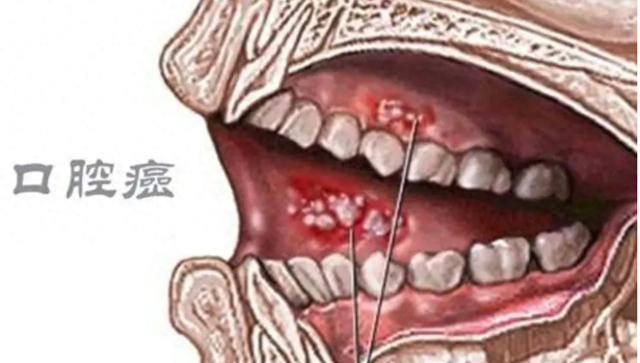 口腔癌|槟榔_新浪新闻