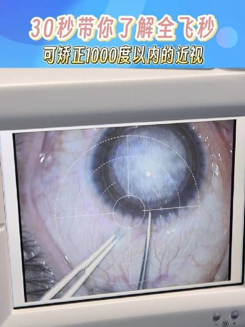 全飞秒的特点是什么它是怎样矫正近视的一个视频说明白