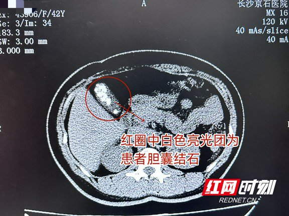 女子春节来长旅游突发腹痛 京石医院专家助其成功保胆取石|胆囊|结石