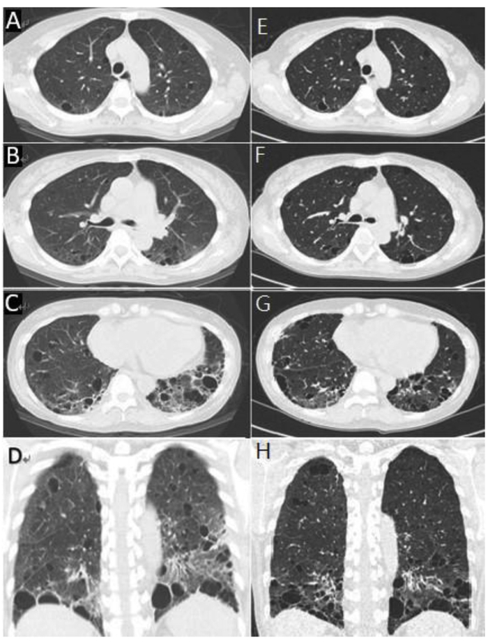 图2A-D、E-H 2015年12月和2016年7月患者胸部CT影像对比