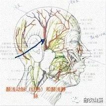 三個半月前,他從高處摔下,磕破了顳淺動脈和顳淺靜脈,在皮下形成了一