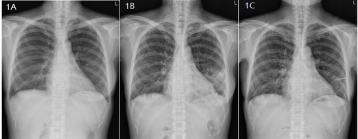 图１ A、B、C分别为2008、2015及2016年胸部X线对比