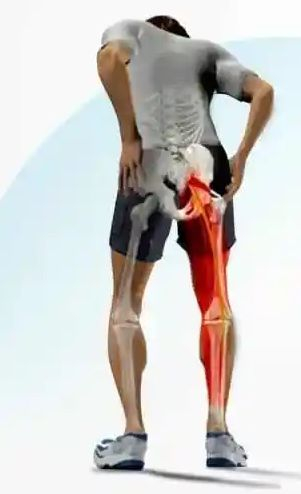 beatty test征:特异性较高,患者侧躺,患侧在上,髋部弯曲60度,膝关节