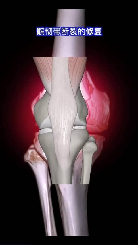 膝盖韧带损伤的症状图片