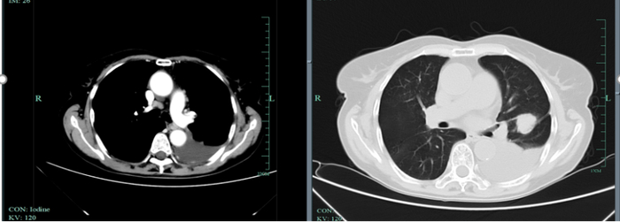 图1. 2020年8月25日胸部CT检查结果