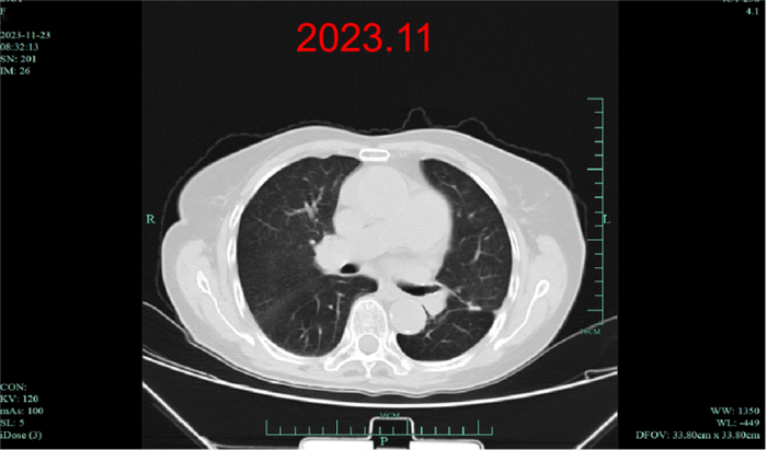 图2. 患者接受达拉非尼+曲美替尼治疗后CT检查结果