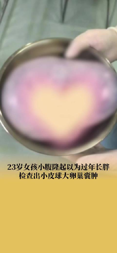 00后女生腹部隆起以为发胖查出20cm囊肿,手术切除皮球大囊肿