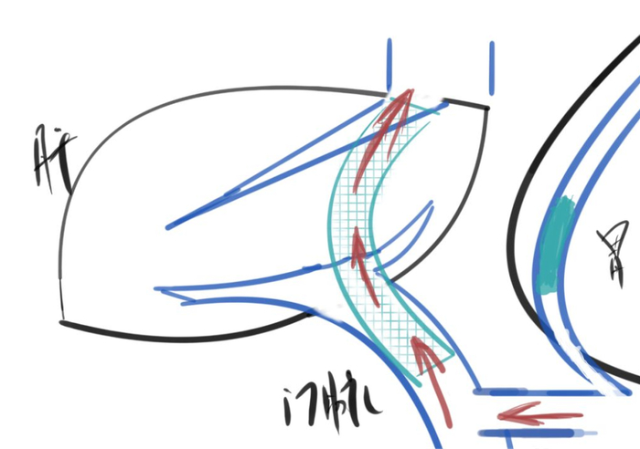 岳阳聋哑患者突然呕血急需手术医护人员画7幅漫画详解手术要点