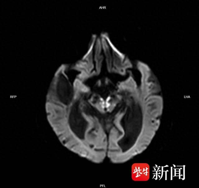 快速诊断精准治疗南通二院成功救治claude综合征罕见病患者