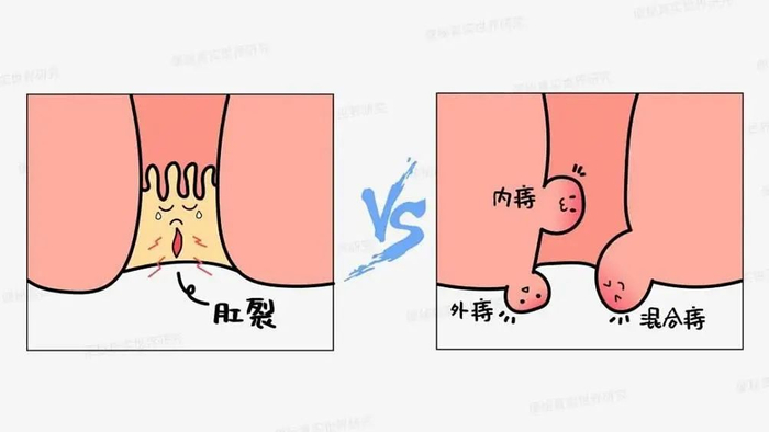 25岁小伙被扶进医院,近期不少人"中招"|肛裂|痔疮|饮食_新浪新闻